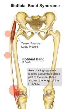 Preventing IT Band Syndrome